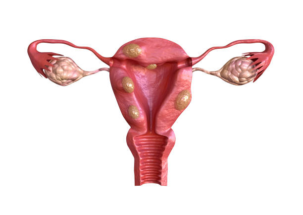 U xơ tử cung là bệnh thường gặp phải ở phụ nữ trong độ tuổi sinh sản