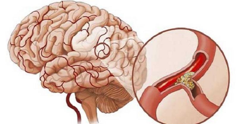 Các di chứng tai biến mạch máu não