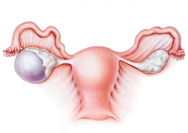 U nang buồng trứng là bệnh phụ khoa phổ biến ở nữ giới