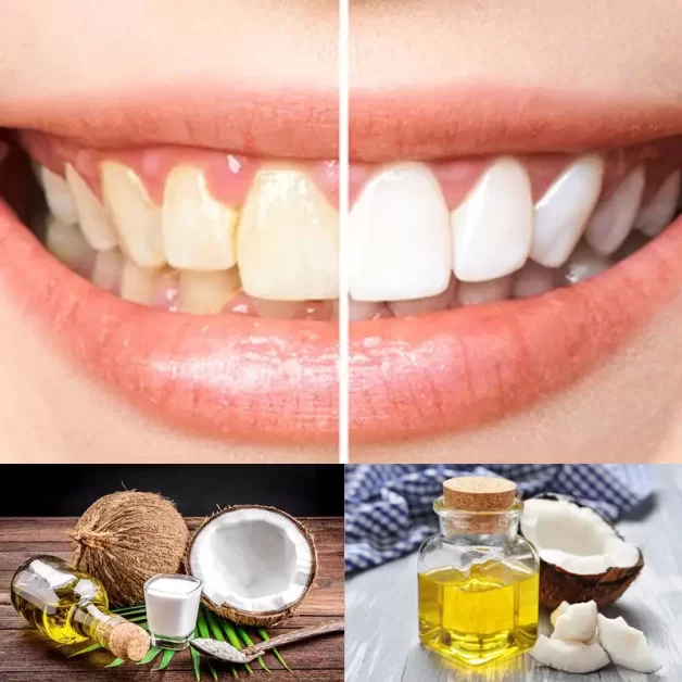 Dầu dừa + Baking soda có tác dụng làm sạch mảng bám và ngăn ngừa sâu răng, bệnh viêm nướu hiệu quả