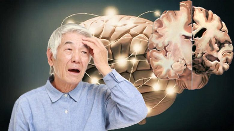 Có rất nhiều nguyên nhân dẫn đến Alzheimer